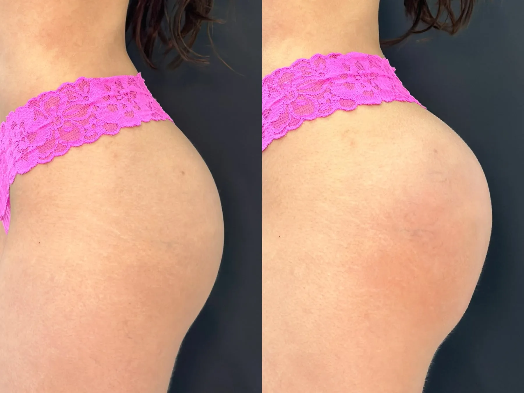 Buttocks at 360° Aesthetics Tijuana