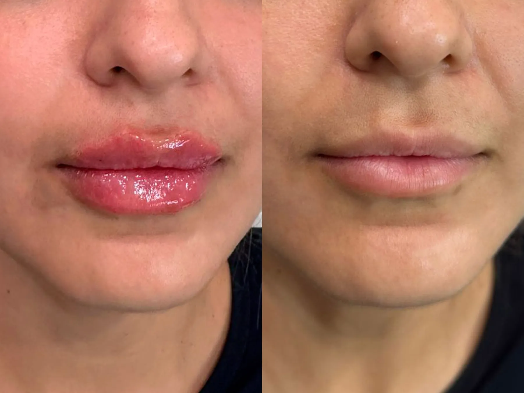 Lips Filler at 360° Aesthetics Tijuana