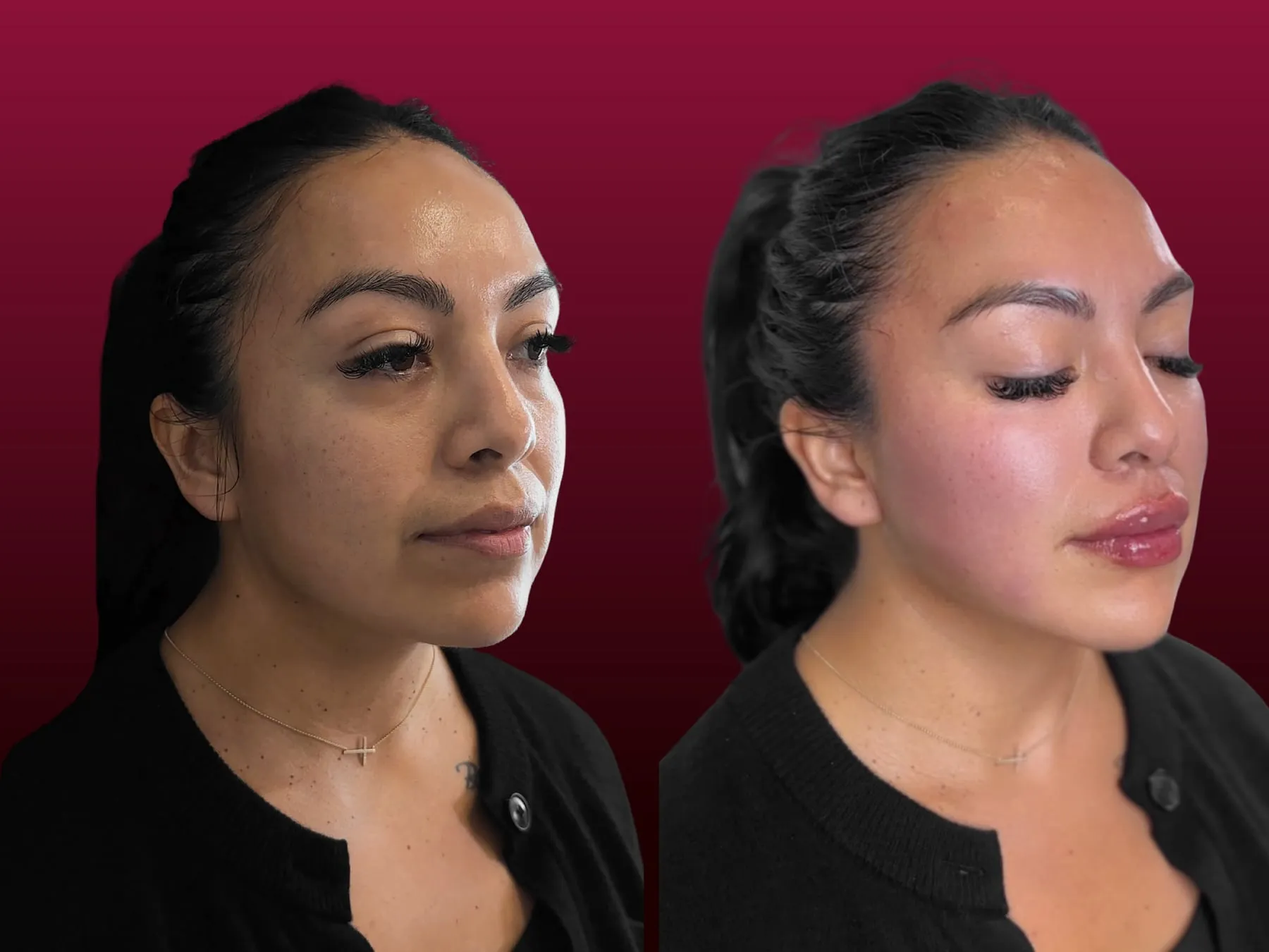 Radiesse Collagen Booster at 360° Aesthetics Tijuana