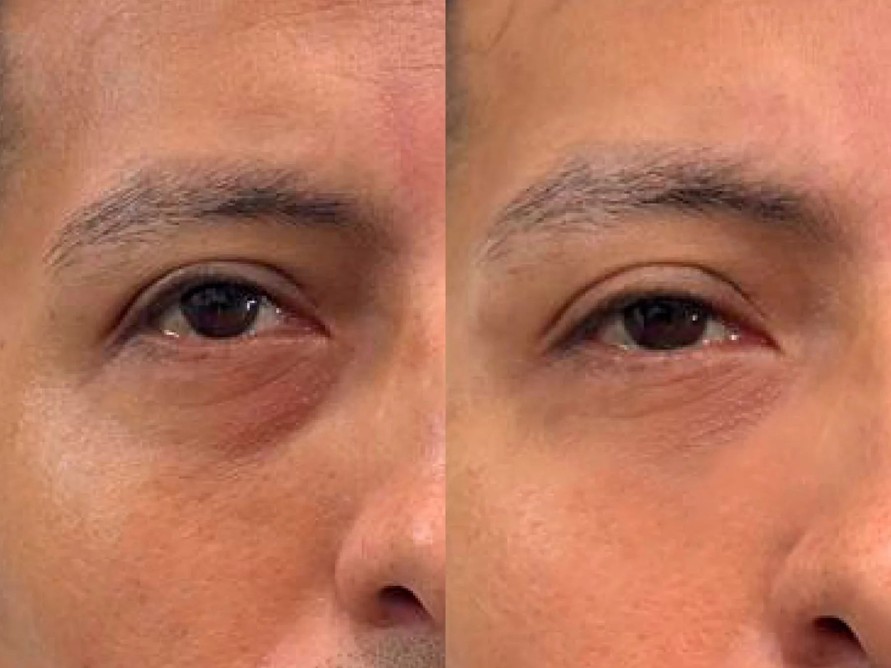 Under-eyes Filler at 360° Aesthetics Tijuana